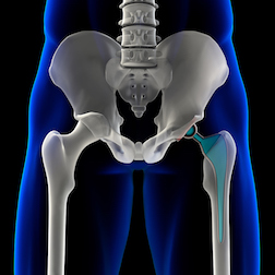The FDA Shortcut to a Hip Replacement Lawsuit