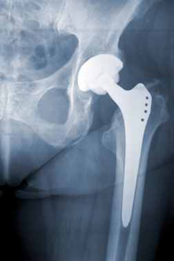 What Should I Do If I Have the DePuy Hip Implant?