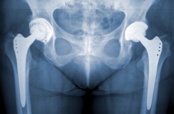 Zimmer Hips—Complaints Surpassing Implants?