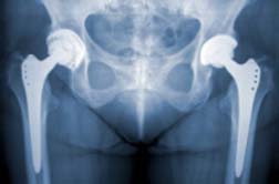 Woman Suffers the Pinnacle of Pain with DePuy Pinnacle