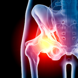 Defective Hip Implant Makers Busy with Recalls, Lawsuits and Settlements