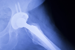 Despite Steep Reduction in Award, Plaintiff’s Defective Hip Implant Verdict Appealed