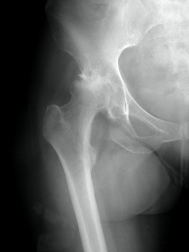 Stryker Rejuvenate Hip Patient shows signs of Metallosis