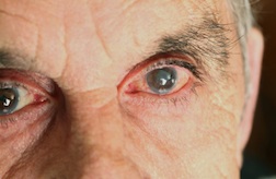 Effexor Linked To Increased Risk of Cataracts
