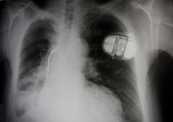 Pacemakers Pose MRI Risk to Patients