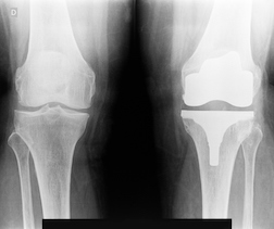 Smith & Nephew Defective Knee Replacements Under the Microscope