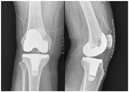 Hip and Knee Replacements Becoming More Common