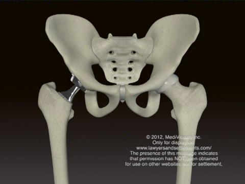 What are the symptoms of a failing hip replacement that has been recalled?